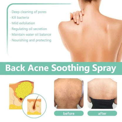 SC SHO Back Acne Spray – Easy, Effective, Acne-Free 🌿
