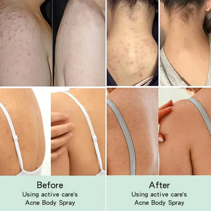 SC SHO Back Acne Spray – Easy, Effective, Acne-Free 🌿